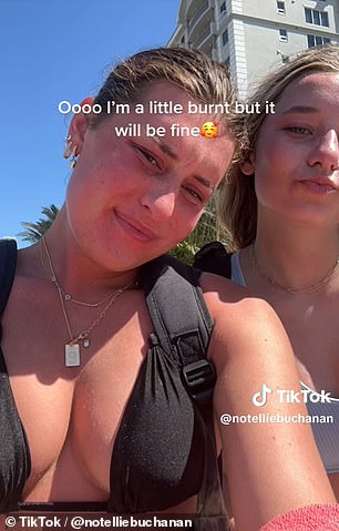 Holidaymakers reveal their sunburn horror stories, from blistering faces to peeling backs