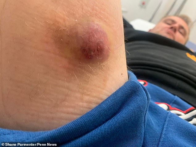‘Britain’s most dangerous spider’ strikes in Essex: Man’s leg swells up like a balloon after a ‘horrific’ bite from a noble false widow